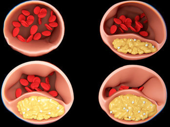 Flohsamen senken den Cholesterinspiegel